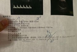 胎儿PSV（胎儿PSV）