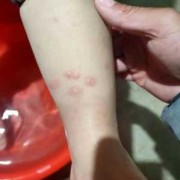孕妇得湿疹怎么办,孕期丘疹性荨麻疹怎么办