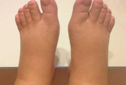 孕期无浮肿正常吗,孕期没水肿正常吗