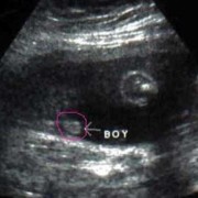 12周胎儿能看出男女吗（孕12周胎儿小鸡彩超图）