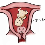 孕期暖巢囊肿（孕期暖巢囊肿会影响胎儿吗）