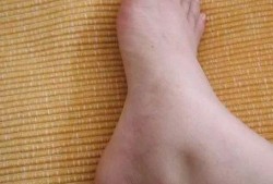 孕期没有水肿正常吗（已经怀孕六个多月了，还没有水肿，但是还会水肿吗？有什么特点）
