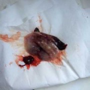 怀孕初期子宫内膜脱落是咋回事啊,孕期子宫内膜脱落出血正常吗