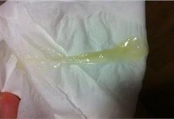 怀孕了白带有什么变化吗,孕期分泌物是什么样的图片