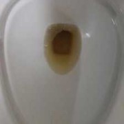 孕期晨尿的颜色像红茶（孕妇尿液发红但是擦了没有血）
