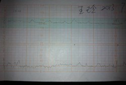 孕妇怎样知道胎儿缺氧,怎么知道胎儿是否缺氧做什么检查