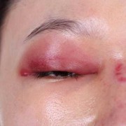 眼睛浮肿是什么原因?吃什么药才好呢,孕期眼睛浮肿是什么原因