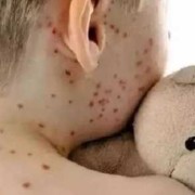孕期感染风疹病毒症状（孕期感染风疹病毒症状）