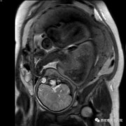 胎儿mri（核磁共振有辐射吗？孕妇可以做吗）