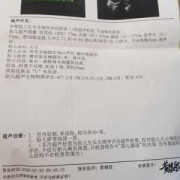 胎儿超声四项生物物理评分（胎儿超声四项生物物理评分8分）