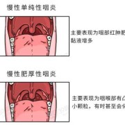 孕期喉咙有痰怎么办（孕期喉咙有痰怎么办又咳不出来咽）