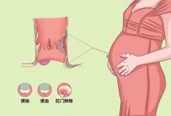 孕妇痔疮出血影响胎儿（孕妇痔疮出血影响胎儿发育吗）