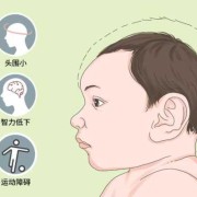 小头畸形的诊断标准是什么,如何排查胎儿小头畸形的原因