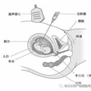 孕期穿刺（羊膜穿刺是检查什么）