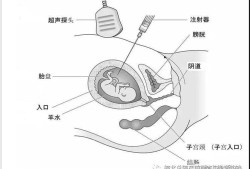孕期穿刺（羊膜穿刺是检查什么）
