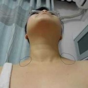 怀孕甲亢的症状有哪些,孕期甲状腺有什么症状表现出来吗?