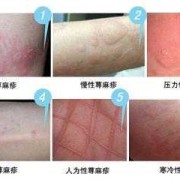 荨麻疹对胎儿（荨麻疹对胎儿有影响吗?）