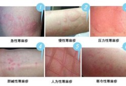 荨麻疹对胎儿（荨麻疹对胎儿有影响吗?）