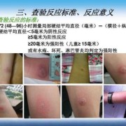 怀孕期间能做吗（结核菌素试验怀孕期间能做吗）