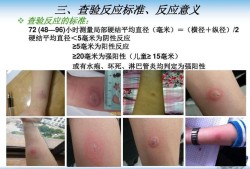 怀孕期间能做吗（结核菌素试验怀孕期间能做吗）
