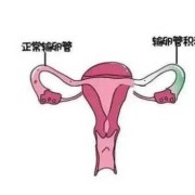 怀孕期间输卵管疼（输卵管通液很痛怎么回事）