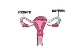 怀孕期间输卵管疼（输卵管通液很痛怎么回事）