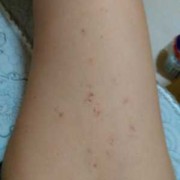 孕期大腿内侧痛（孕期大腿内侧红了一块，又痛是怎么回事）