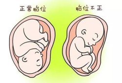 胎儿为什么胎位不正（胎儿为什么胎位不正呢）