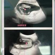 怀孕15周的症状,怀孕15周胎儿稳定了吗会胎停吗