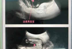 怀孕15周的症状,怀孕15周胎儿稳定了吗会胎停吗