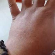 孕期腕管综合症（孕30周了，手肿麻木正常吗）