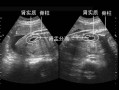 孕晚期胎儿肾盂分离（37周胎儿左肾肾盂分离啥意思啊？胎儿的左肾怎么会分离了呢）