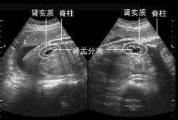 孕晚期胎儿肾盂分离（37周胎儿左肾肾盂分离啥意思啊？胎儿的左肾怎么会分离了呢）