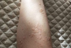 荨麻疹怀孕影响胎儿吗（孕妇身上起风团对胎儿有影响吗）
