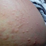 孕期长痘（孕期为什么肚子长痘）