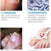 孕期灰指甲怎么办（孕妇有灰指甲怎么办?）