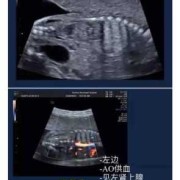 胎儿隔离肺能自愈吗,胎儿隔离肺属于严重问题吗