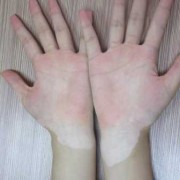 白癜风具有遗传性吗,自癜风能在孕期自愈吗女性
