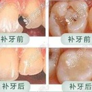 孕期补牙（怀孕能补牙吗）