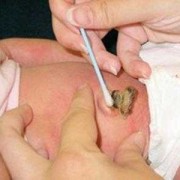 胎儿脐带脱落（新生儿脐带什么时候脱落）