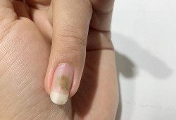 灰指甲用药会影响怀孕吗,备孕期能做指甲吗贴甲片