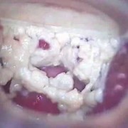 白带跟豆腐渣一样怎么回事,孕期白色豆腐渣分泌物