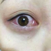 眼睛痒是怎么回事，眼睛痒是什么原因引起,孕期眼睛痒怎么办越揉越痒