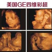 孕期二级筛查（孕妇28周到32周做二级四维彩超主要检查胎儿什么）