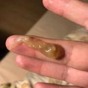 为什么孕中期会出现宫颈粘液栓,孕期易栓症是什么