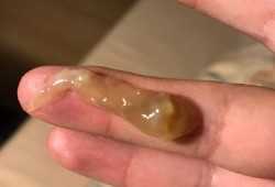 为什么孕中期会出现宫颈粘液栓,孕期易栓症是什么