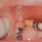 怀孕期间牙齿能打麻醉吗,怀孕期间打麻药的影响大吗