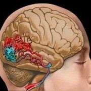 胎儿脑畸形（脑血管畸形会遗传吗）