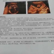 胎儿左右心室有强光点怎么办（胎儿左右心室有强光点怎么办33周）