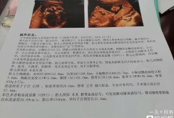 胎儿左右心室有强光点怎么办（胎儿左右心室有强光点怎么办33周）